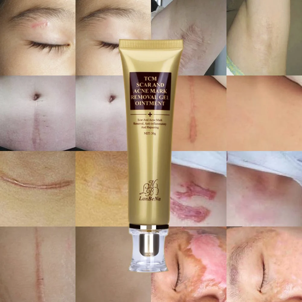 Acne Scar Remover Cream - Image 5