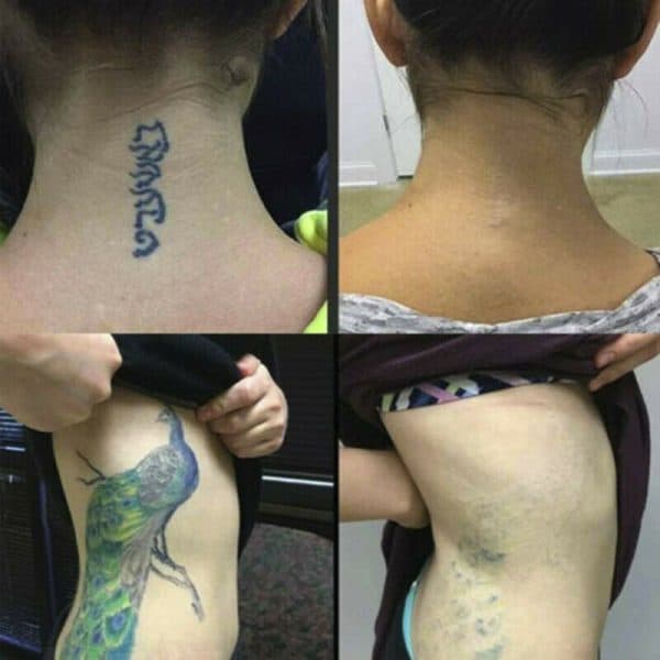 Permanent kräm för borttagning av tatueringar