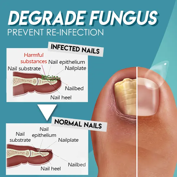 Dotorus™ Fungus Nail Repair Gel