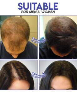 Micro-Needle Hair Growth