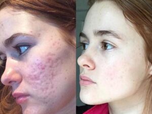 Derma Roller - New Anti-age Needling Technology