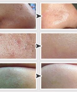 Dermation™ Vacuum Suction Pore Cleanser