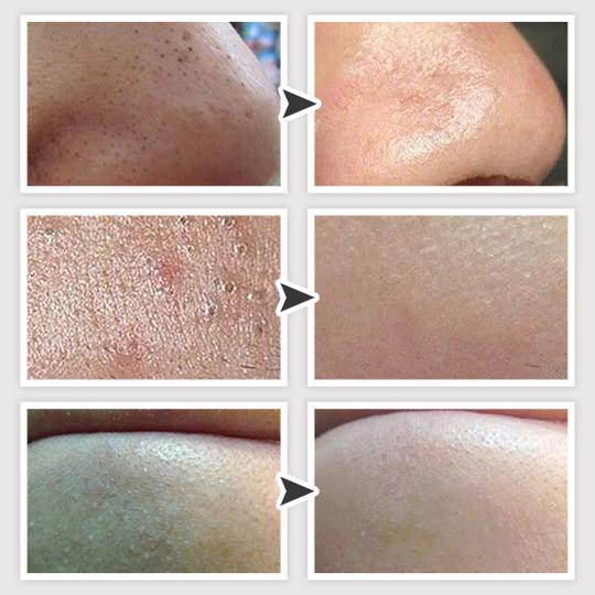 Dermation™ Vacuum Suction Pore Cleanser Wowelo