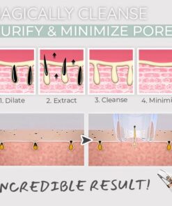 Dermation™ Vacuum Suction Pore Cleanser