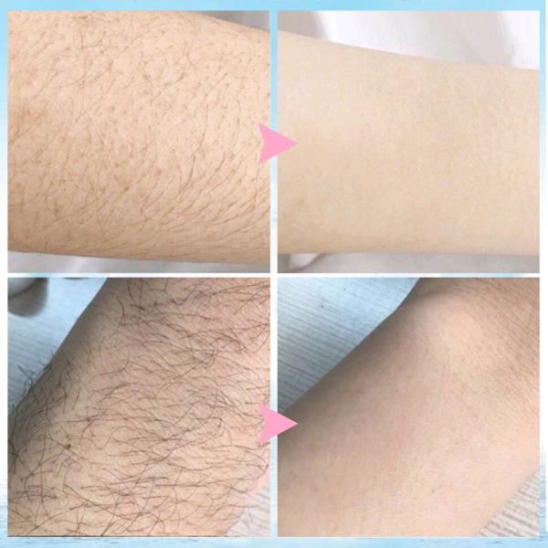 🔥 2021 Magic Hair Removal & Hair Inhibitor【Buy 5+ Get Extra 25% OFF】