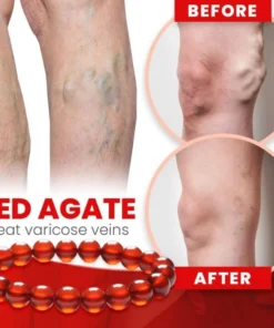 Red Agate Varicose Vein Cure Anklet