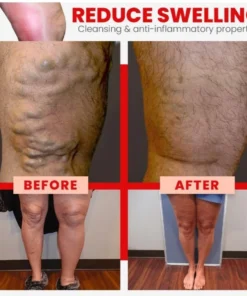 Red Agate Varicose Vein Cure Anklet