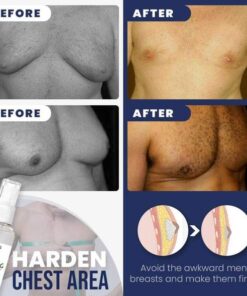 Gynecomastia Cellulite Melting Spray