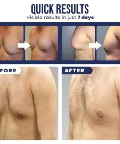 Gynecomastia Cellulite Melting Spray