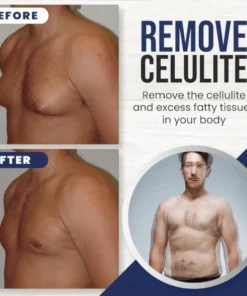 Gynecomastia Cellulite Melting Spray