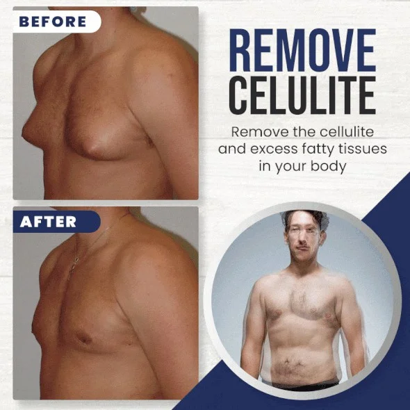 Gynecomastia Cellulite Melting Spray