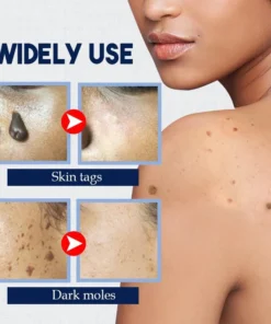 (🔥Hot Summer Sale - 50% OFF)SkinTag Instant Remover Cream💝BUY 1 GET 1 FREE!!