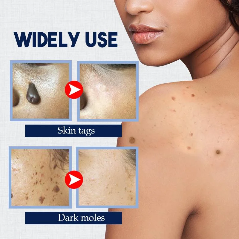 (🔥Hot Summer Sale - 50% OFF)SkinTag Instant Remover Cream💝BUY 1 GET 1 FREE!!