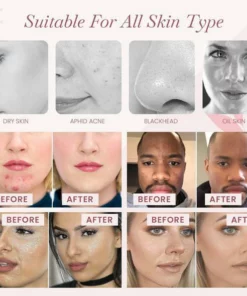 PureSkin™ Silk Fibroin Acne Fighting Soap