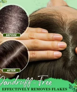 Anti-Dandruff Treatment Essence