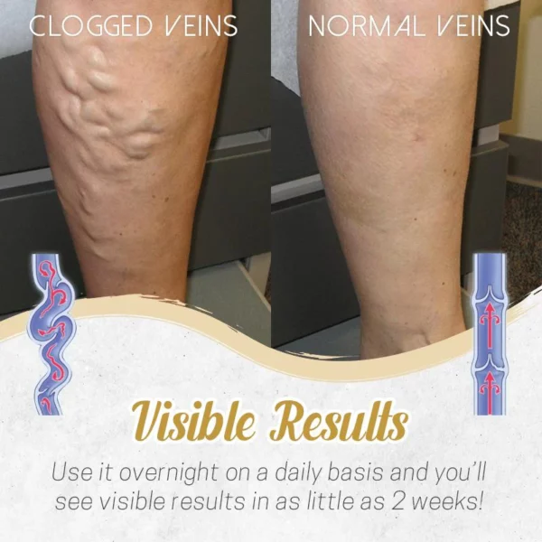 Herbal Detox Patch para sa Varicose Veins