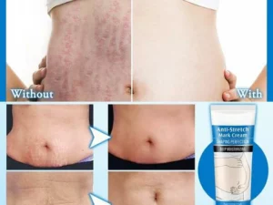 Striae Off™ Anti-Stretch Mark Cream