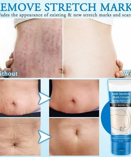 Striae Off™ Anti-Stretch Mark Cream