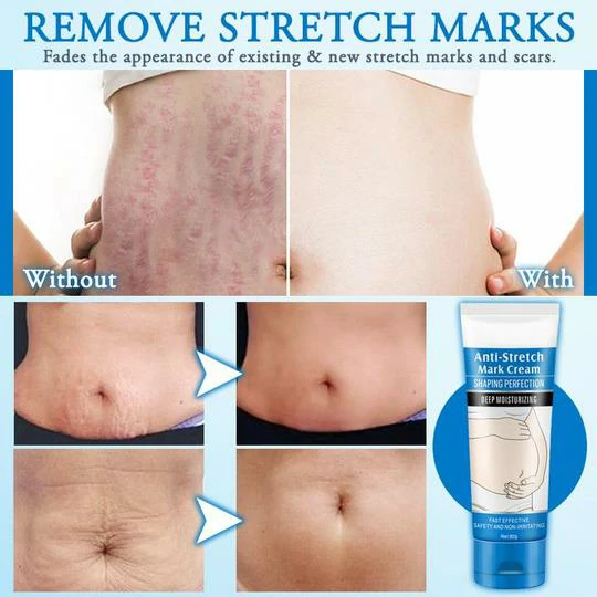 Striae Off™ Kareemka Ka-hortagga Stretch Mark