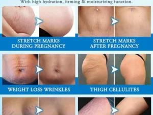 Striae Off™ Anti-Stretch Mark Cream