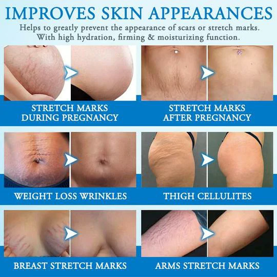 Striae Off™ Kareemka Ka-hortagga Stretch Mark