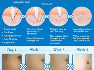 Striae Off™ Anti-Stretch Mark Cream