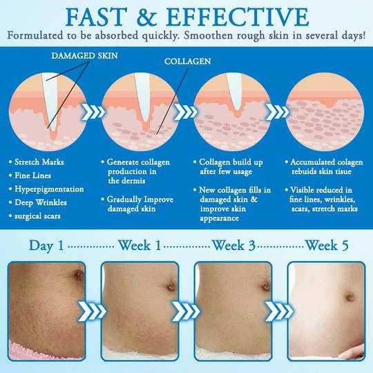 Striae Off™ Anti-stretch Mark Cream