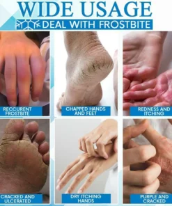 FrostbiteFree Skin Restoration Ointment