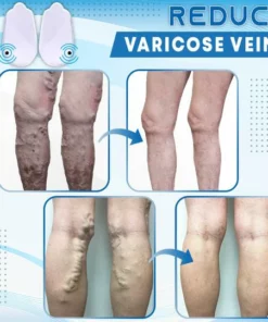 MagnetCure™ Anti-Varicose Veins Shoes Pad