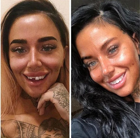 THE WHITEBRIGHT SNAP ON SMILE