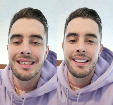 THE WHITEBRIGHT SNAP ON SMILE