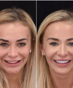 THE WHITEBRIGHT SNAP ON SMILE