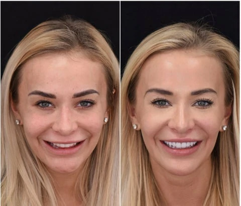 THE WHITEBRIGHT SNAP ON SMILE