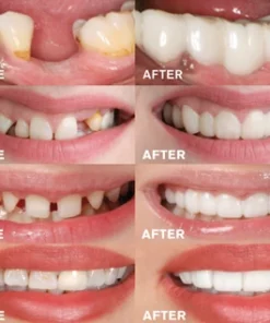 THE WHITEBRIGHT SNAP ON SMILE