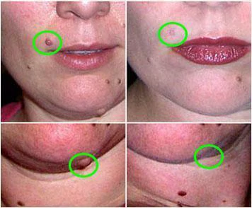 Mole & Skin Tag Removal Solution
