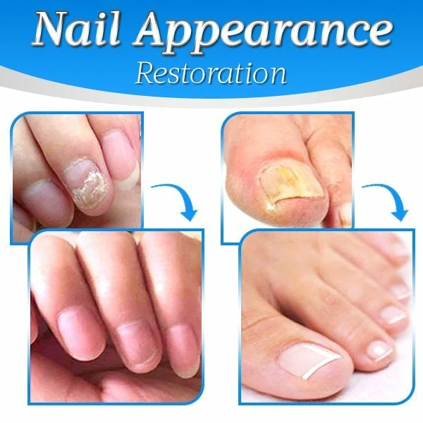 Nailthy™ Fungus Nail Repair Gel