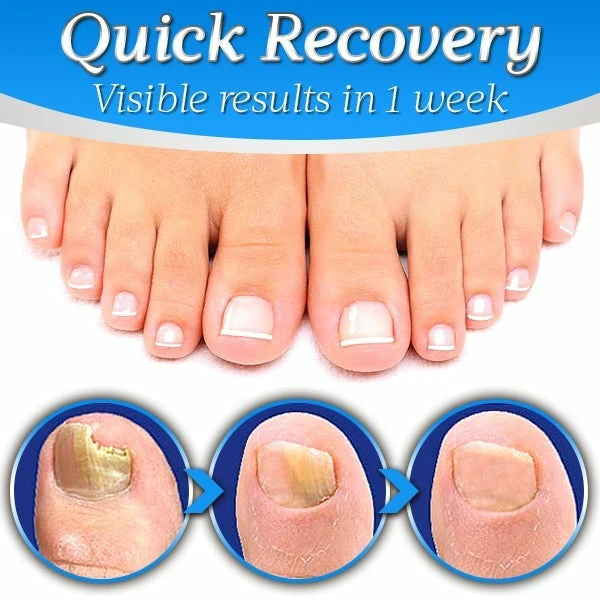 Nailthy™ Fungus Nail Repair Gel