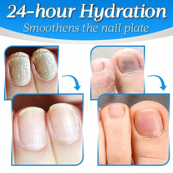Nailthy™ Fungus Nail Repair Gel