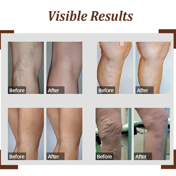 LegVeins OrganicPatch.