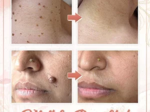 Herbal Wart Skin Removal Ointment