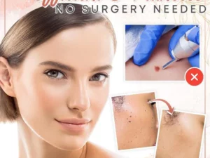 Herbal Wart Skin Removal Ointment