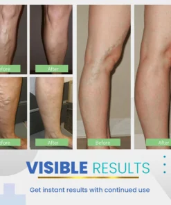 BeauSkin Spider Veins Repair Cream