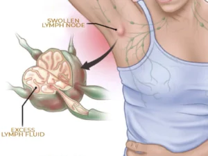 LymphaticDrainage Detoxification GingerOil