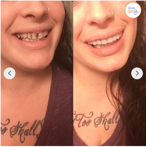 Perfect Smile👨‍⚕Justerbare, avtakbare proteser😁 (💥48% RABATT) - 🔥Hot Sale🔥🎉