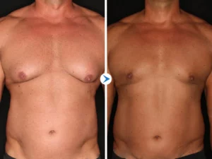 GynoOut Chest Tightening Spray