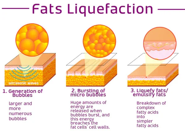 KOMO ULTRASONIC LIQUEFACTION HAND STRAP