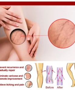 Varicose Veins Relief Cream