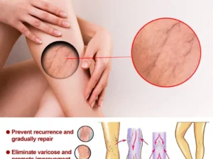 Varicose Veins Relief Cream