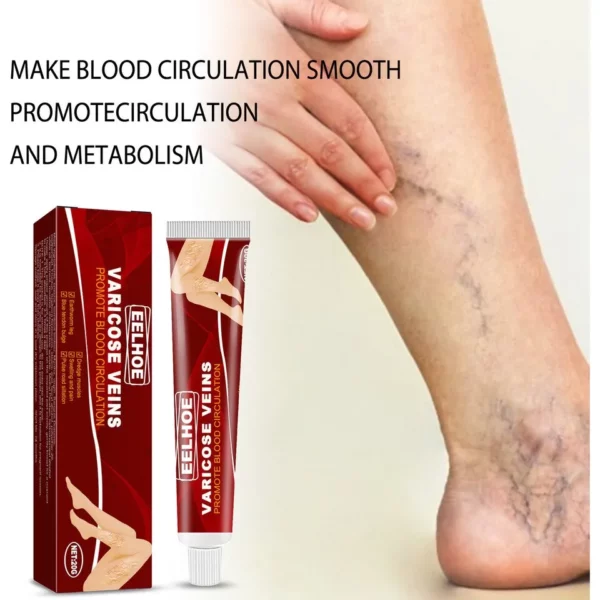 Varicose Veins राहत क्रीम