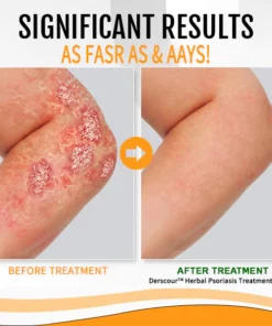 Derscour™ Herbal Psoriasis Treatment Soap